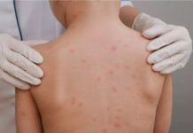 Cidade de SC registra primeiro caso confirmado de meningite bacteriana em 2025