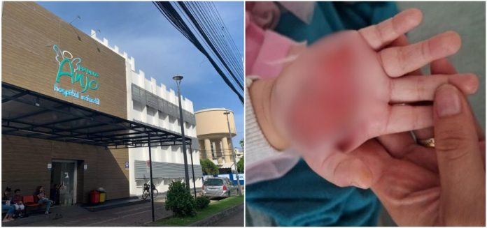 Em Itajaí, madrasta é detida após queimar mão de criança de dois anos com colher quente