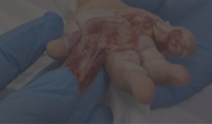 Lesao na mao de Antonella evidencia a urgencia do tratamento